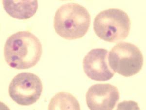 Eritròcits infectats per Plasmodium